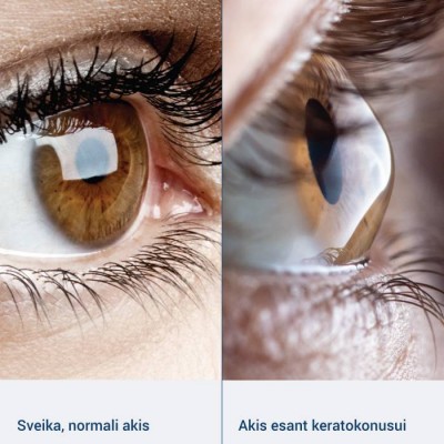 Akis su keratokonusu Akis su keratokonusu