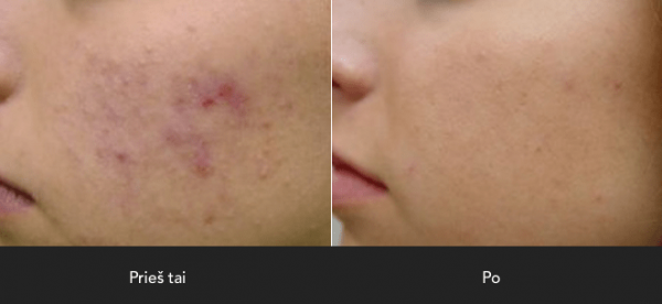 Foto Aknes gydymas lazeriu. Pries PO