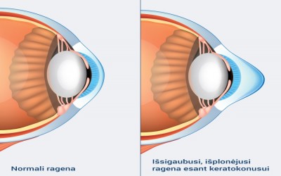 Keratokonusas Keratokonusas
