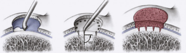 Kelio kremzlės mikrolūžių formavimo operacija Kelio kremzlės mikrolūžių formavimo operacija