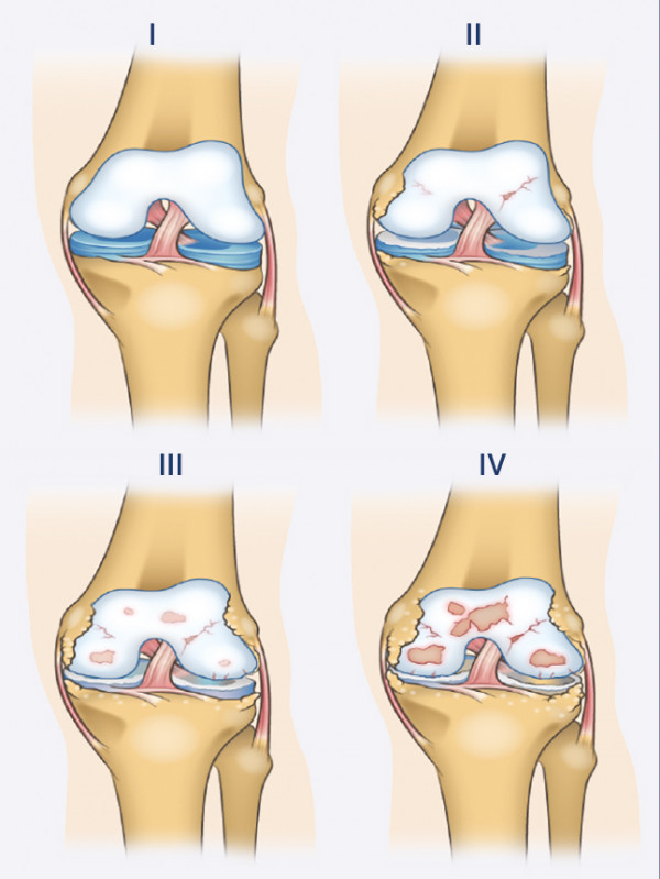 Kelio kremzlės pažeidimo laipsniai Kelio kremzlės pažeidimo laipsniai
