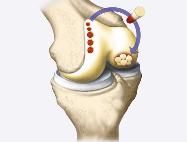 Kelio kremzlės pažeidimo mozaikoplastika Kelio kremzlės pažeidimo mozaikoplastika
